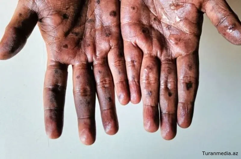 Mpox в Центральной Африке: новая угроза и глобальный вызов